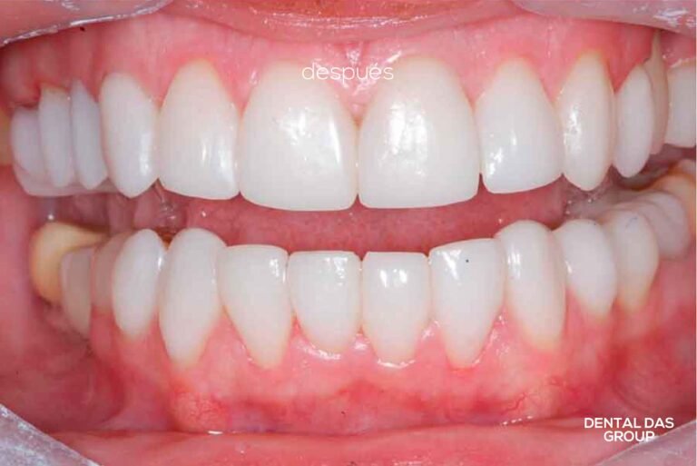 Cuánto cuestan las carillas dentales en Argentina 2 Cuánto cuestan las carillas dentales en Argentina