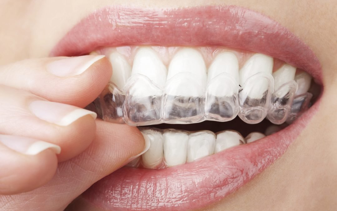 donde puedo encontrar carillas dentales removibles en argentina