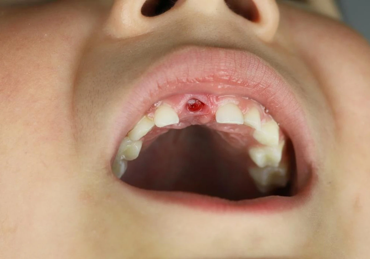 que significa sonar que se te rompe un diente y su interpretacion